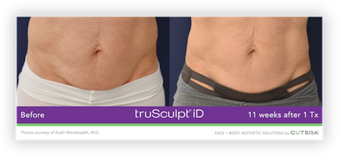 truSculpt® iD Before After 4
